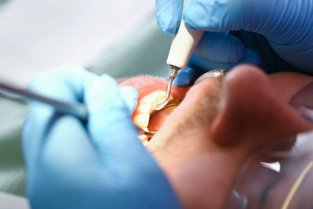 Best Emergency Tooth Extraction in North Augusta, SC